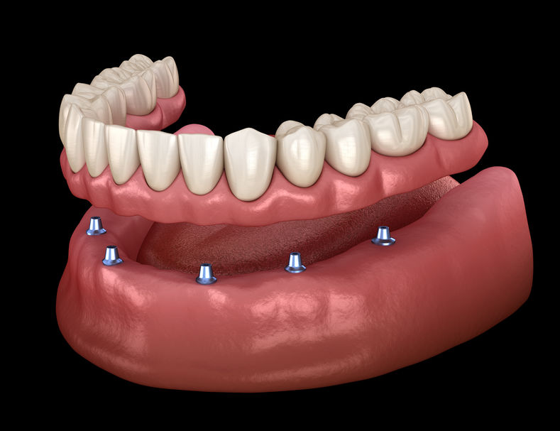 Dentures/Partials